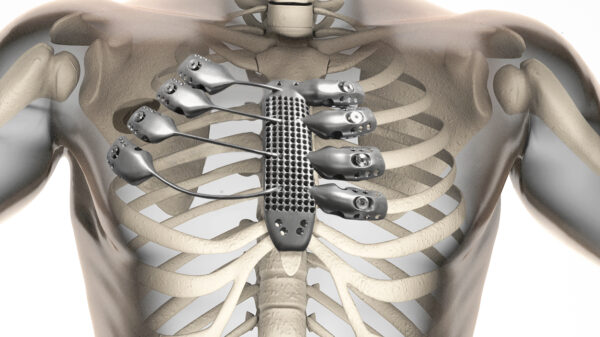 3d printed sternum illustration 600