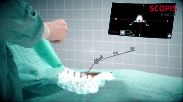 Microsoft HoloLens becomes an AR assistant for spinal surgery 600